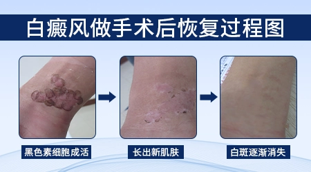 大腿根部皮肤有一块白块怎么回事