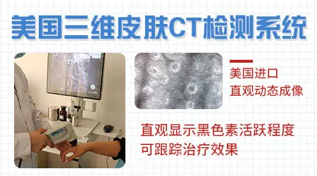 卤米松治白癜风用多久没有副作用