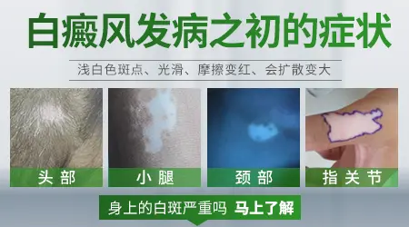 汗斑与白斑的区别