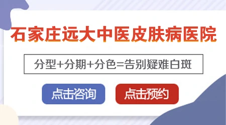 白癜风不同阶段都是什么颜色