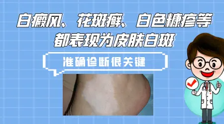 孩子皮肤有白色斑点是什么皮肤病