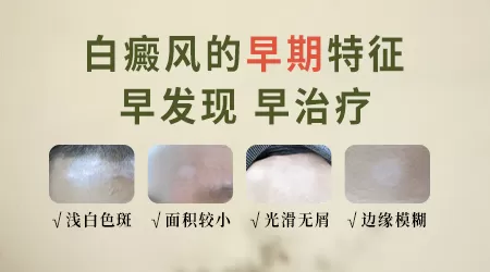 白癜风的早期症状图