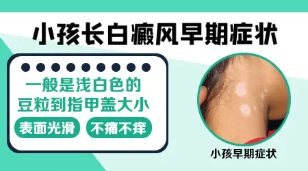 小孩白癜风白点图