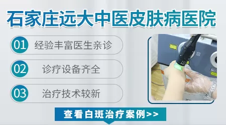 白癜风除了照激光还有没有好的办法