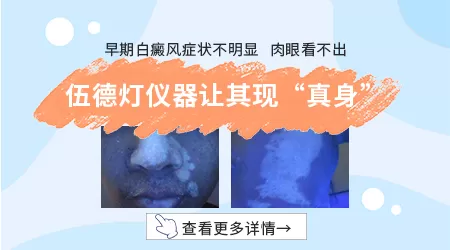 不同类型白斑病的图片