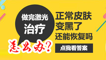 308照白癜风照在正常皮肤上有影响吗