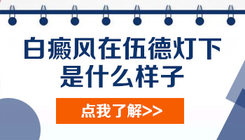 用伍德光照白斑显示亮白色是不是白癜风