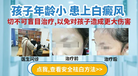 小孩手脚都有白斑会是白癜风吗