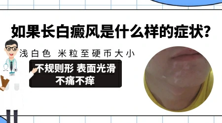 新冠后得白癜风是身体免疫力低吗