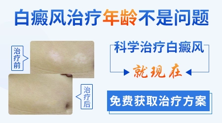 中医药浴治疗白癜风的配方