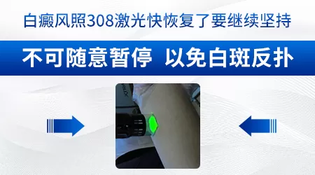 308激光治白斑一次多少钱