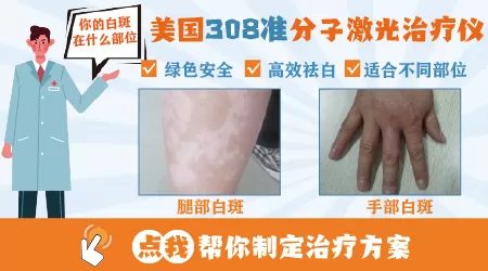 308准分子激光照完白癜风的样子