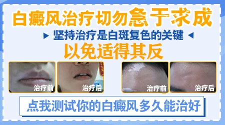 白癜风做光疗有用吗