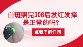 308激光治疗白癜风皮肤一直是红色的怎么回事