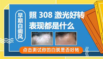 308准分子激光照白斑多久会有好转反应