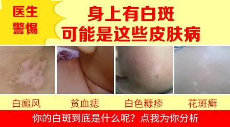 手指背关节有小白点是白癜风吗