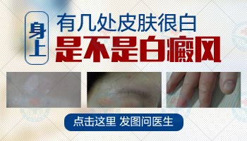 长了白斑就会是有白癜风吗