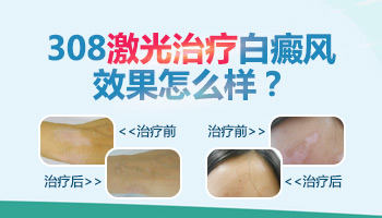 308nm准分子激光照白癜风出黑点还有必要继续照吗