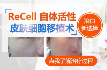 recell培植治疗白癜风效果怎么样