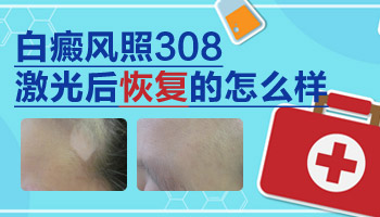 照308nm激光后白斑还多了是怎么回事